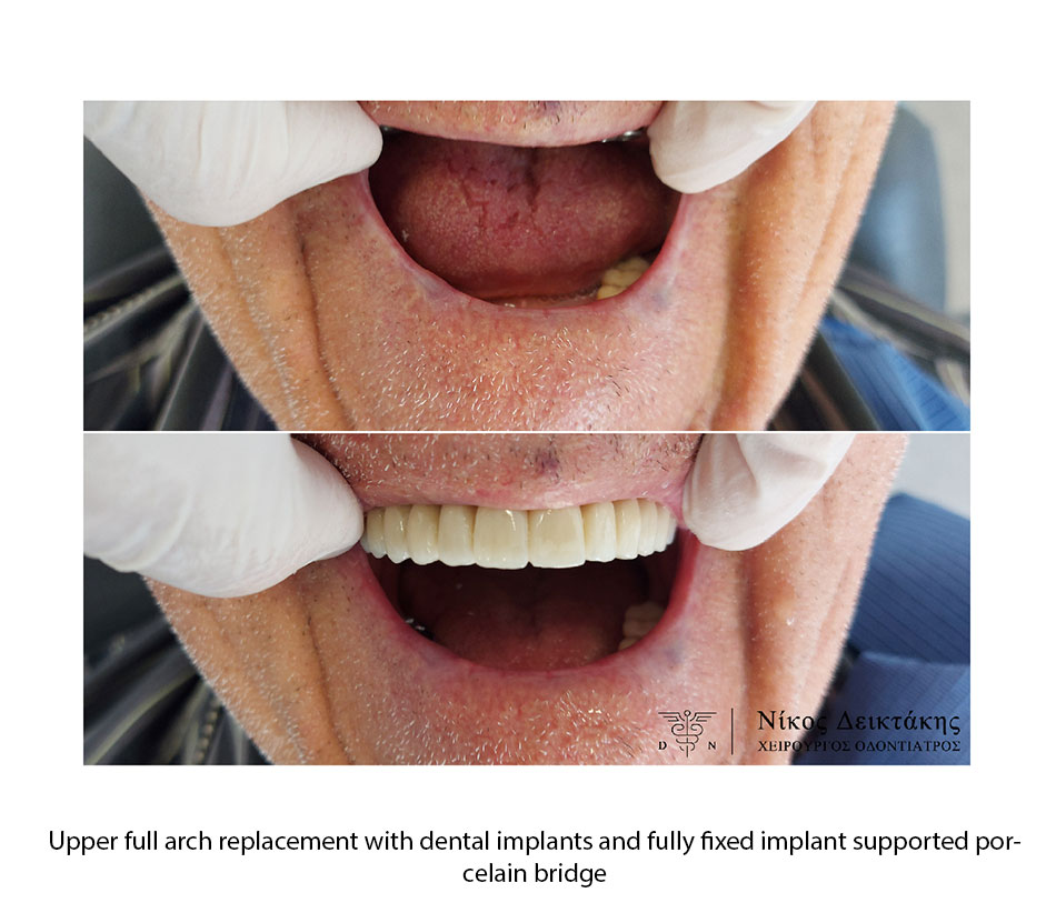 DENTAL IMPLANTS