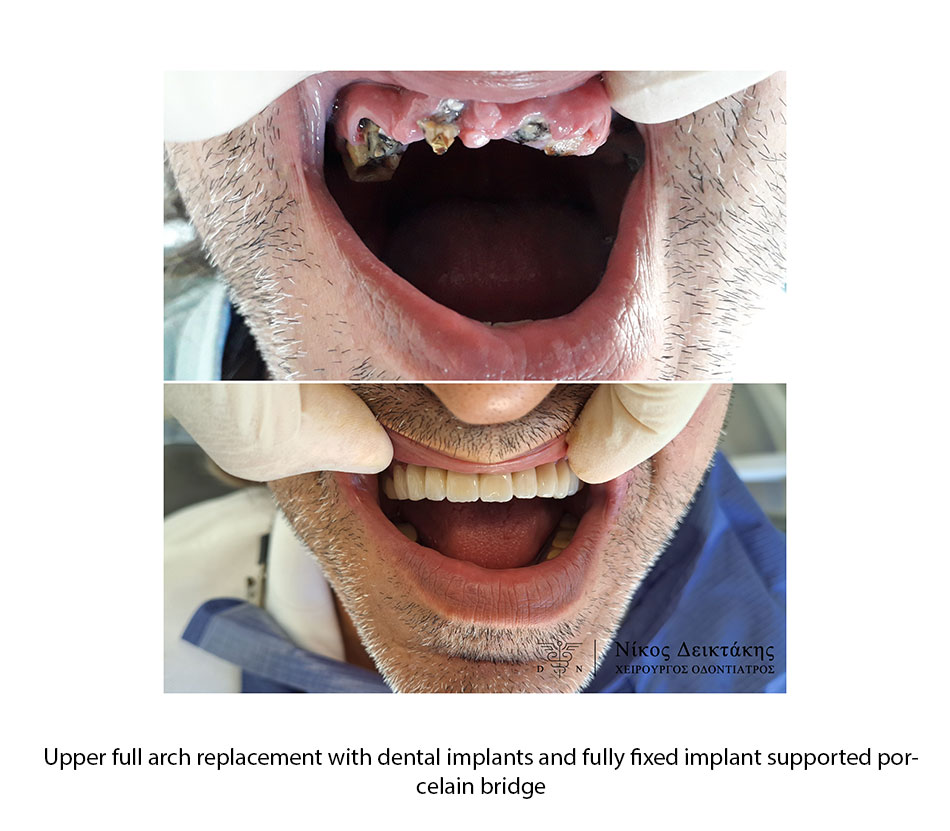 DENTAL IMPLANTS