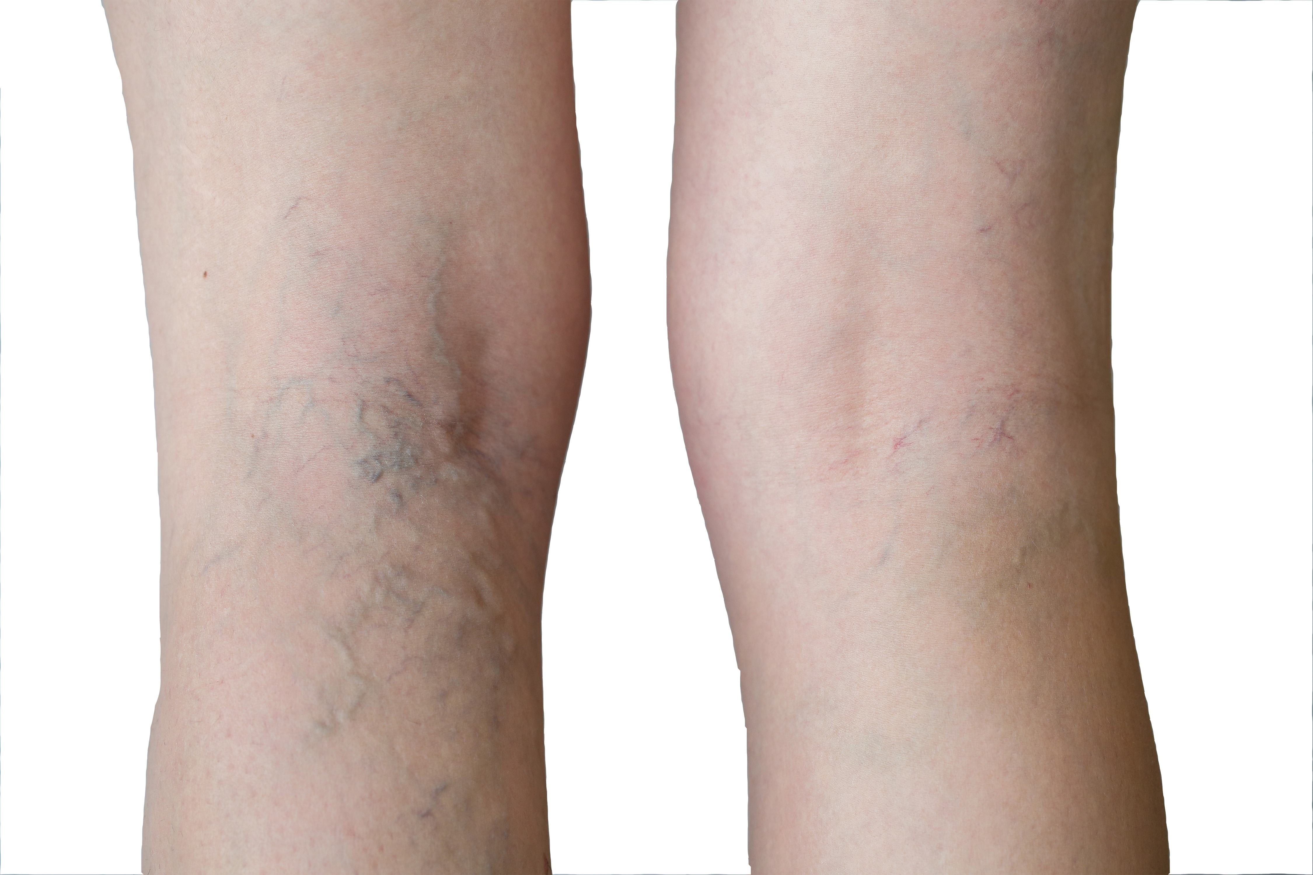 SPIDER VEINS REMOVAL
