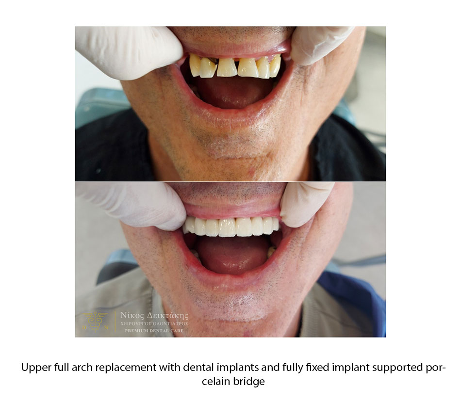 DENTAL IMPLANTS