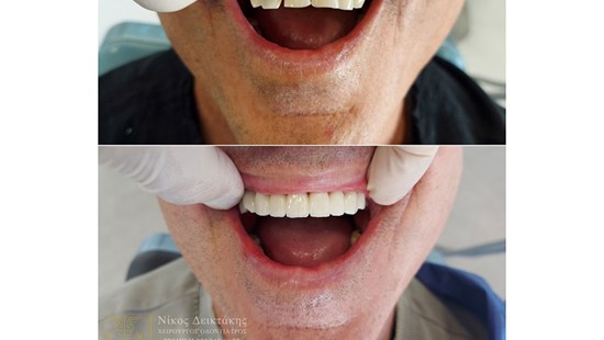 DENTAL IMPLANTS
