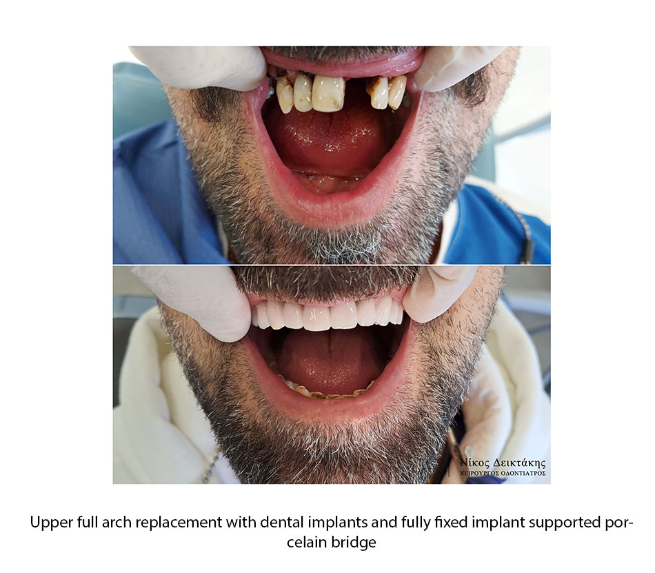DENTAL IMPLANTS