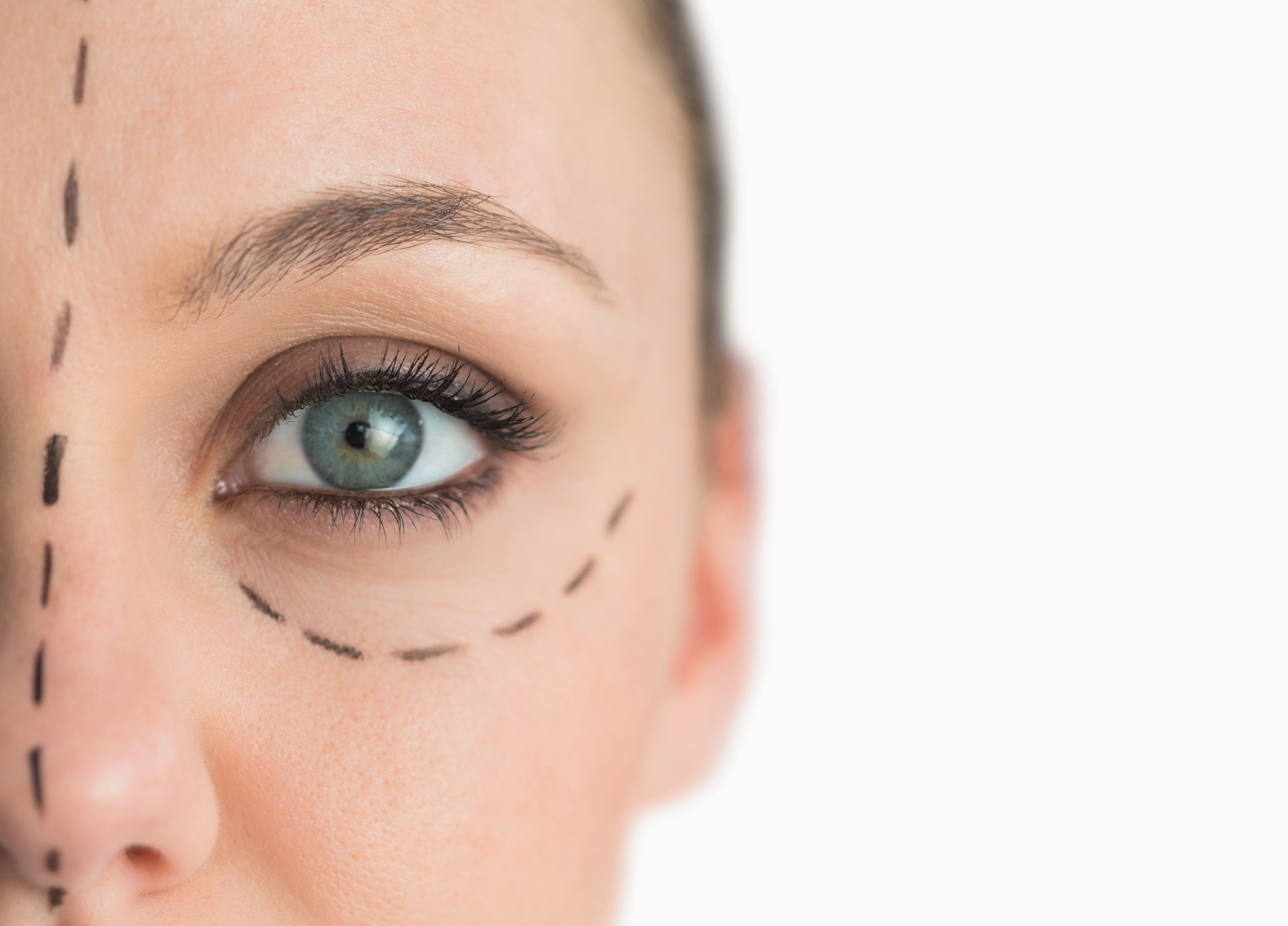 BLEPHAROPLASTY