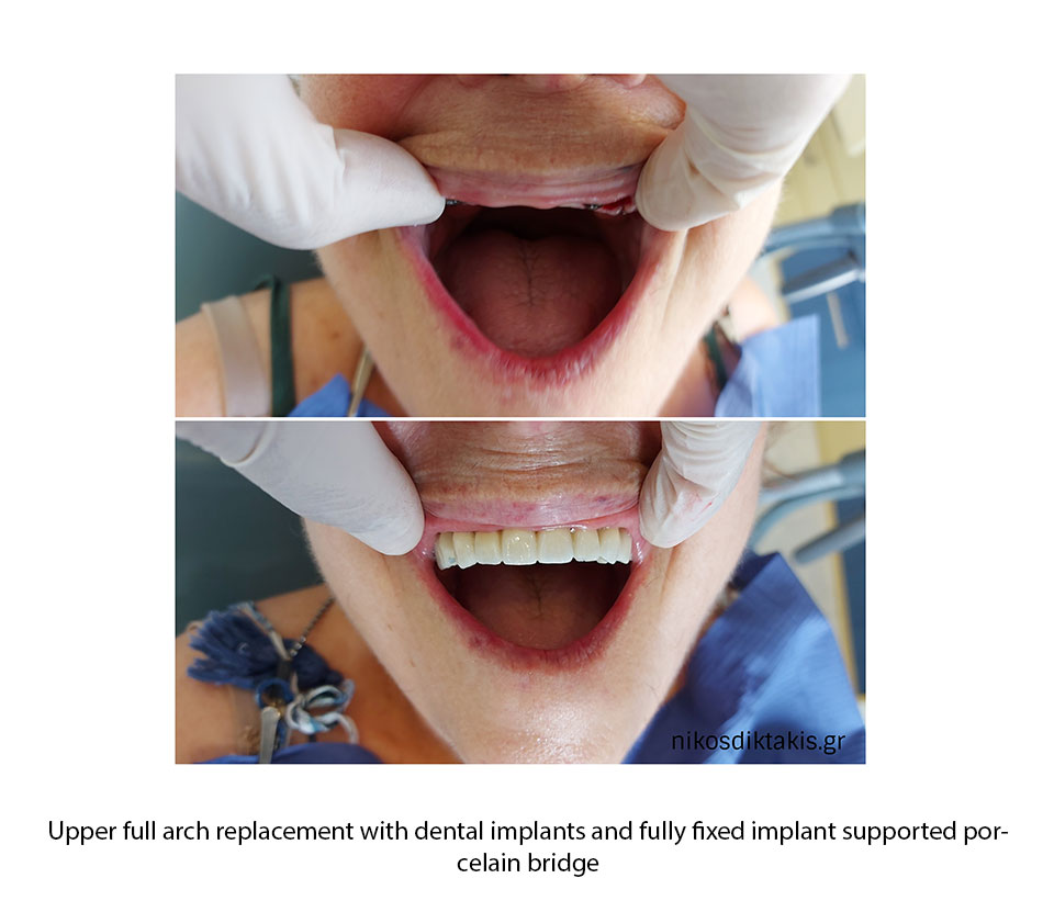 DENTAL IMPLANTS