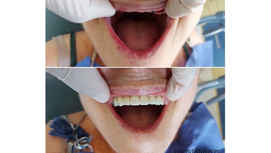 DENTAL IMPLANTS